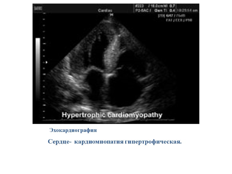 Эхокардиография  Сердце-  кардиомиопатия гипертрофическая.